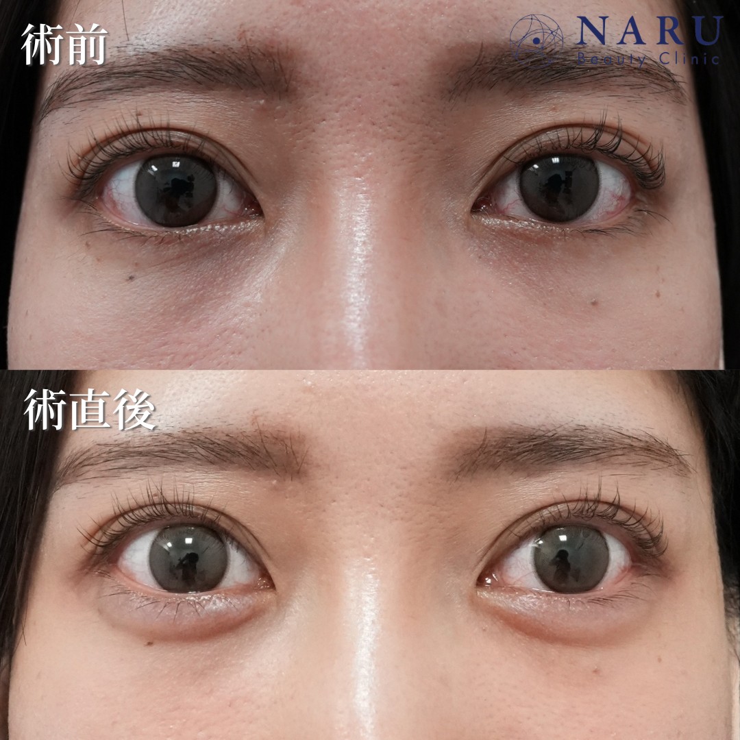 20代女性　涙袋ヒアルロン酸