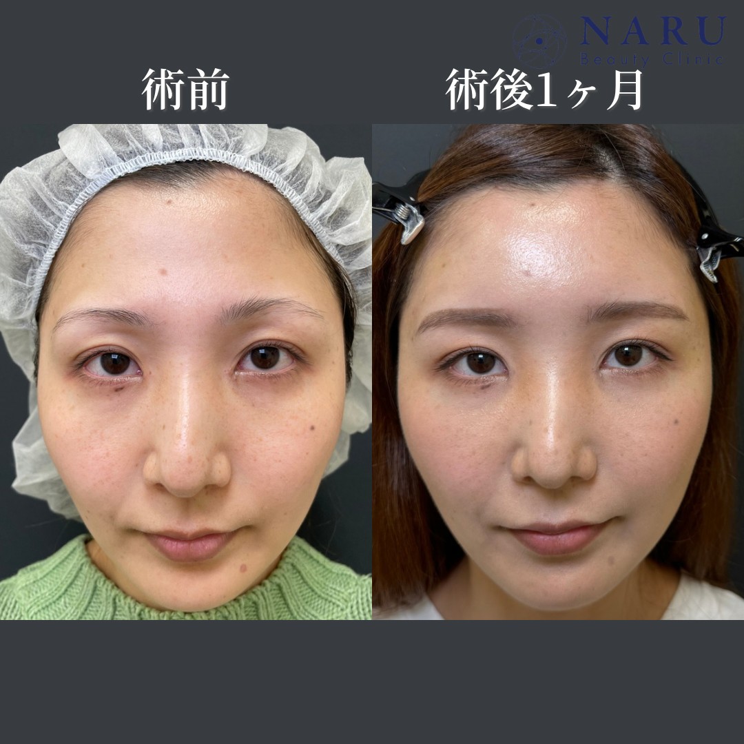 20代女性　額脂肪注入