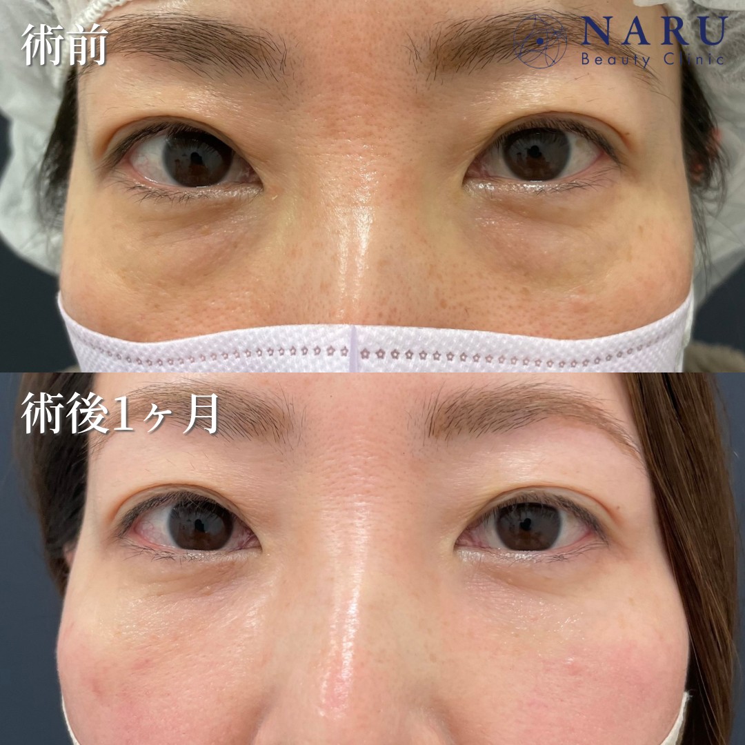 40代女性　クマ取り＋目の下脂肪注入