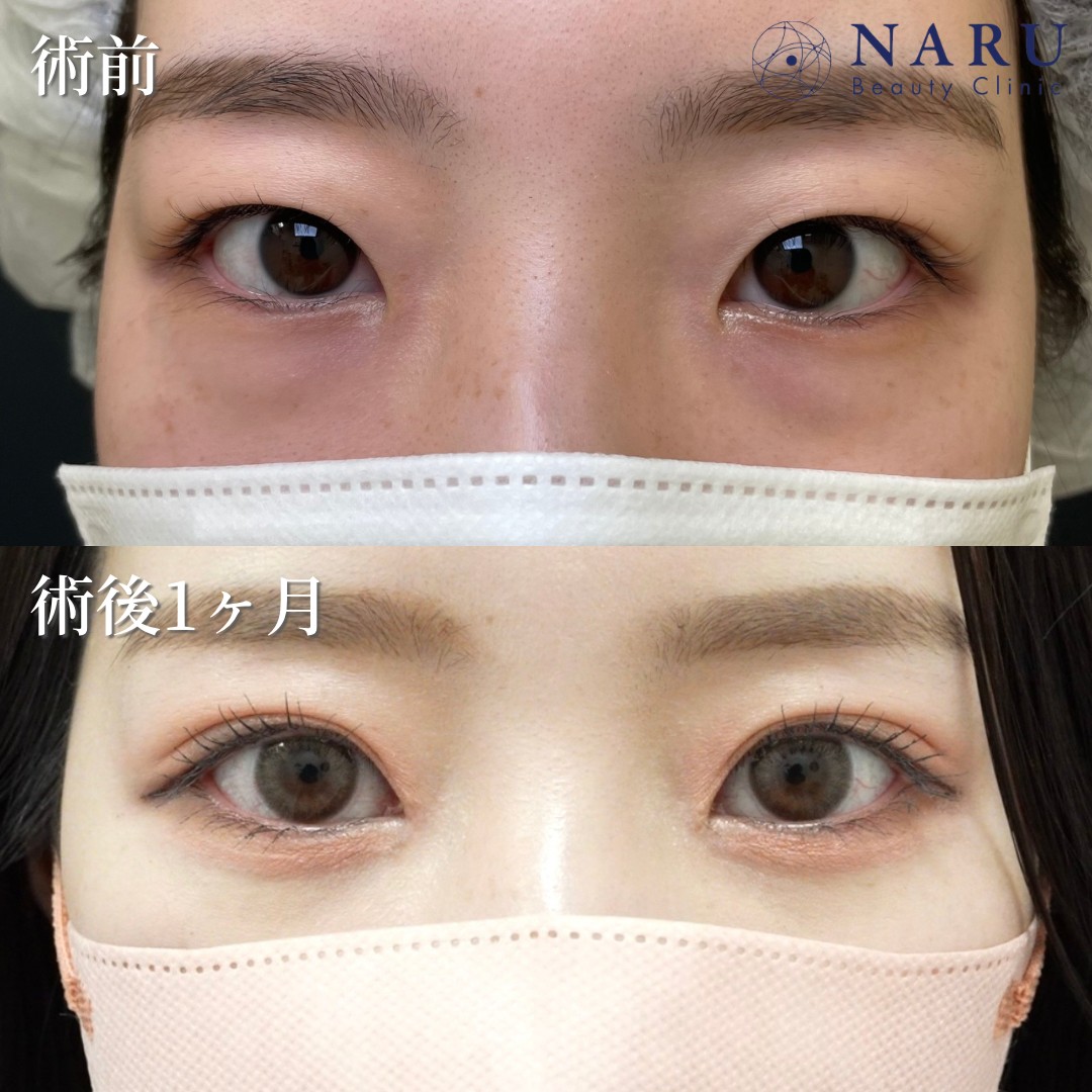 20代女性　二重埋没法＋目頭切開＋クマ取り