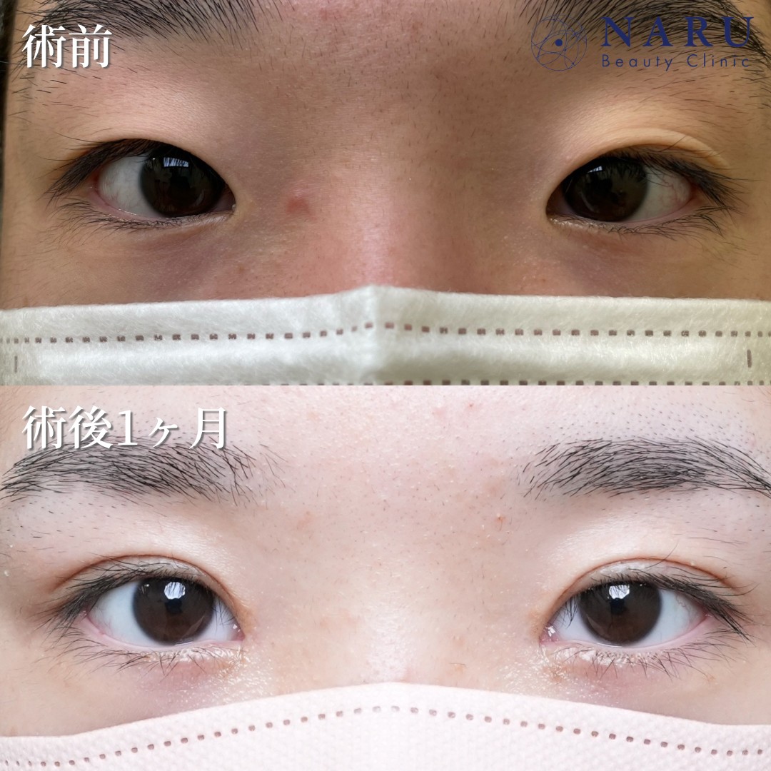 10代女性　二重埋没法＋目頭切開