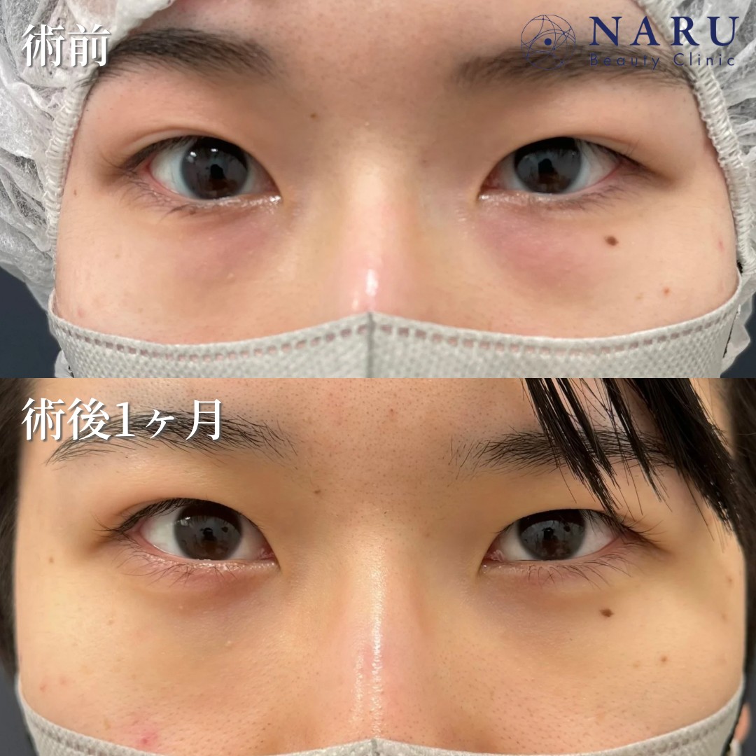 20代女性　クマ取り