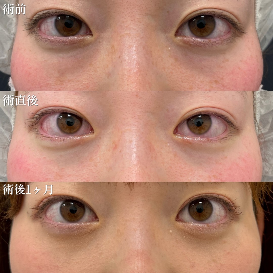 20代女性　クマ取り