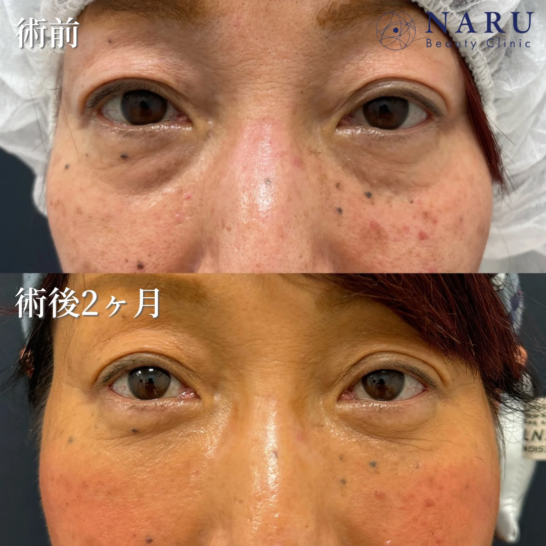 50代女性　クマ取り＋脂肪注入