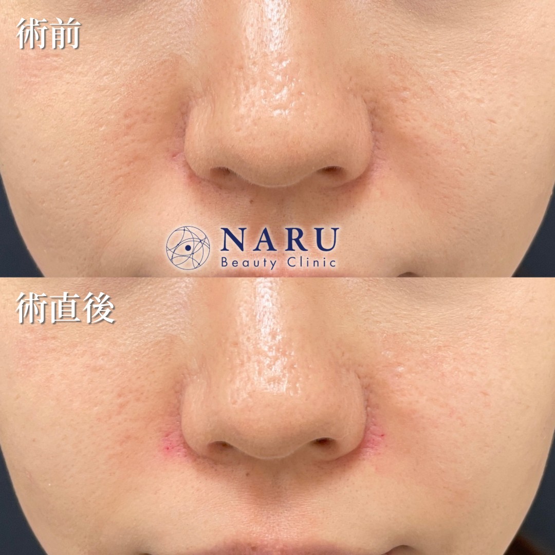 20代女性　貴族ヒアルロン酸