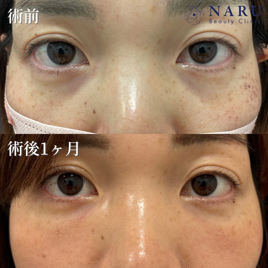 30代女性　クマ取り＋脂肪注入