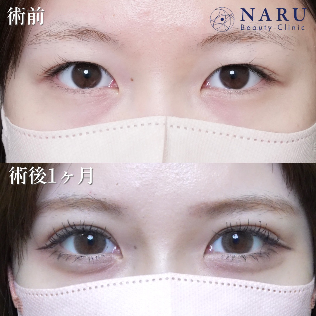 20代女性　二重埋没法