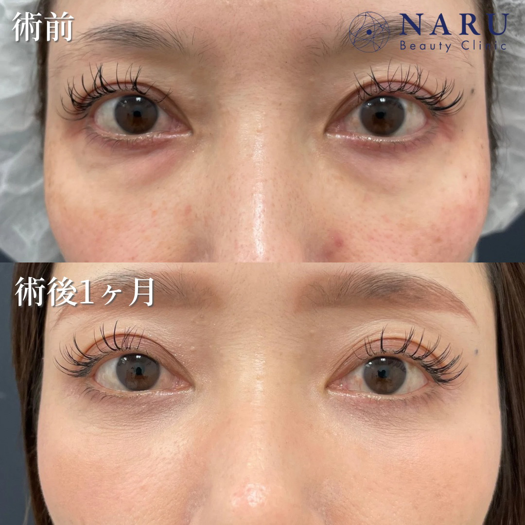 40代女性　クマ取り