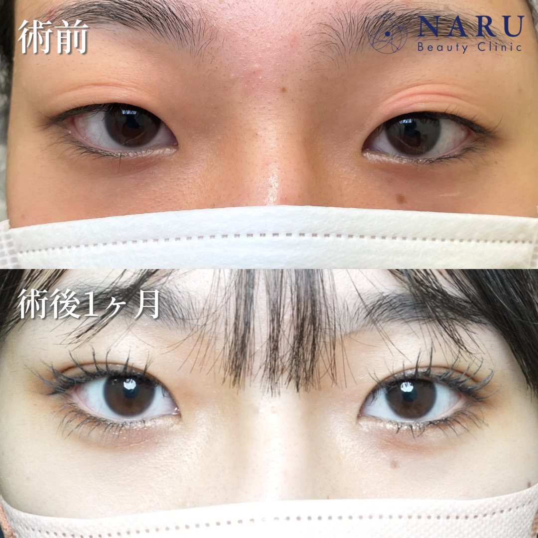 10代女性　二重埋没法