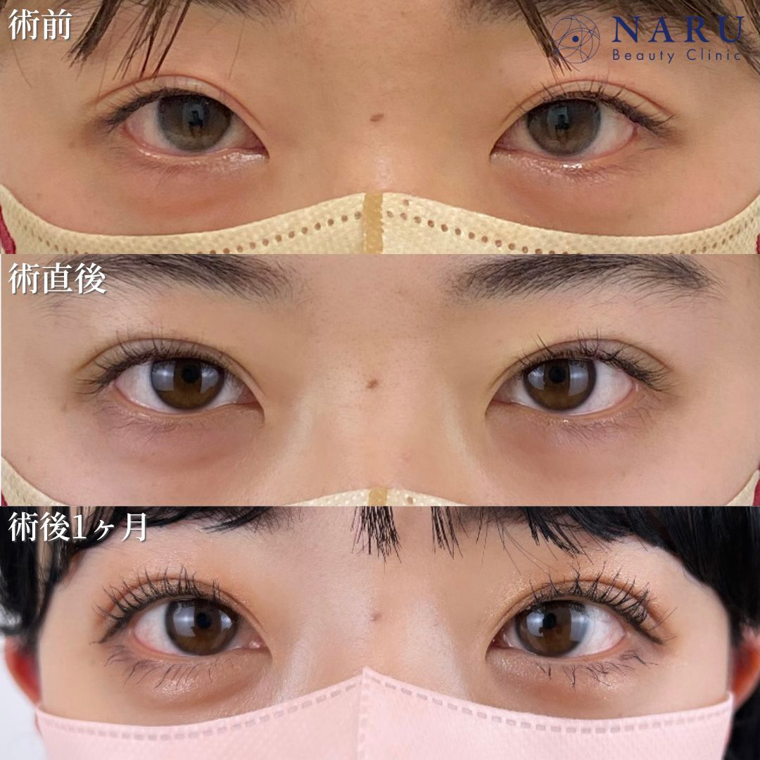 20代女性　二重埋没法