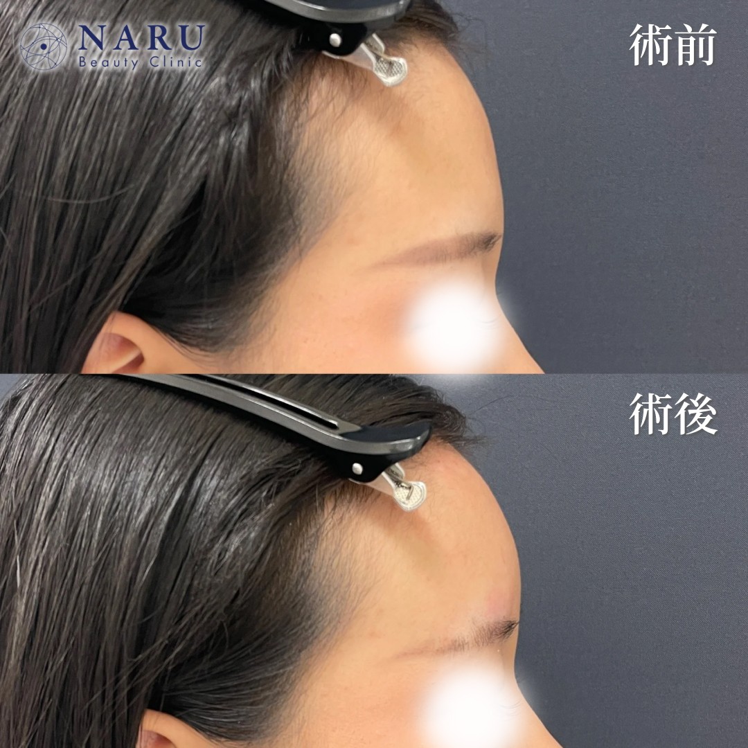 20代女性　額ヒアルロン酸