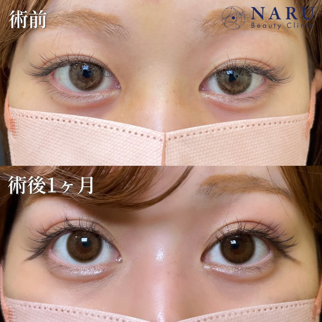 20代女性　二重埋没法