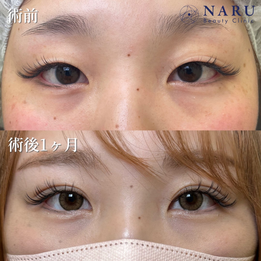 20代女性　二重埋没法