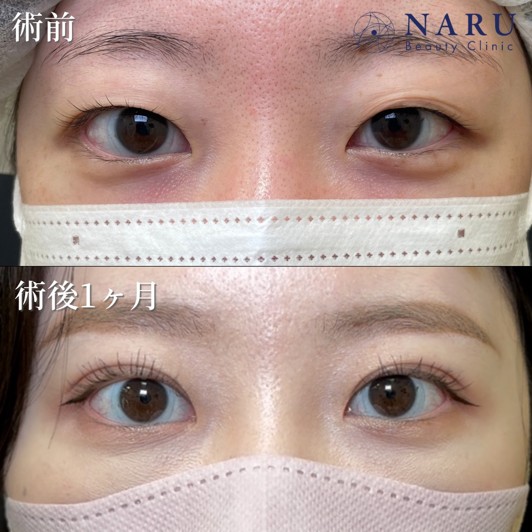 20代女性　二重埋没法