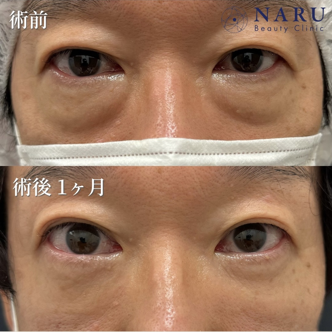 40代男性　クマ取り＋目の下脂肪注入