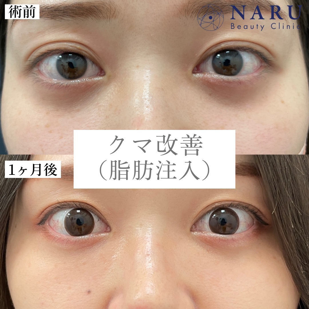 20代女性　目の下脂肪注入