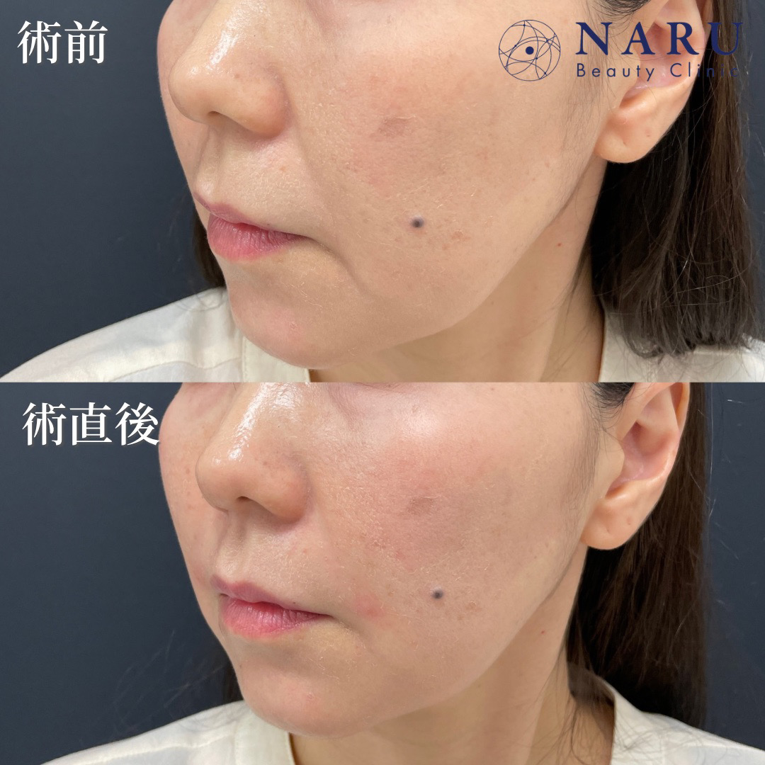 40代女性　貴族ヒアルロン酸