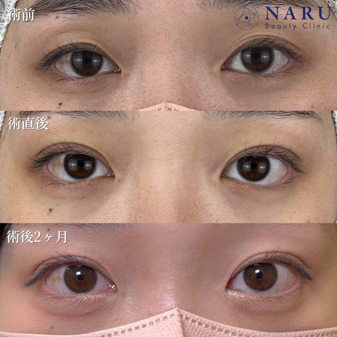 20代女性　二重埋没法