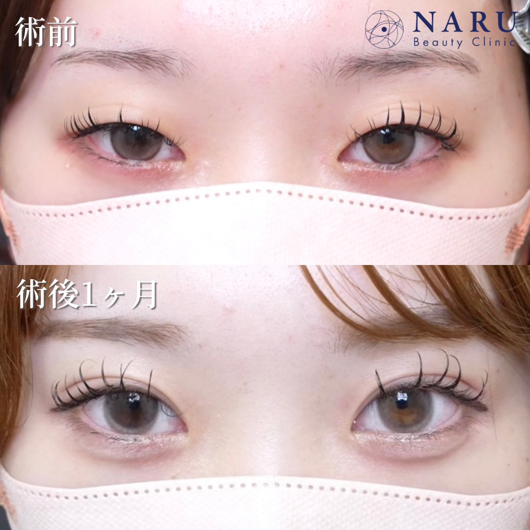 20代女性　二重埋没法