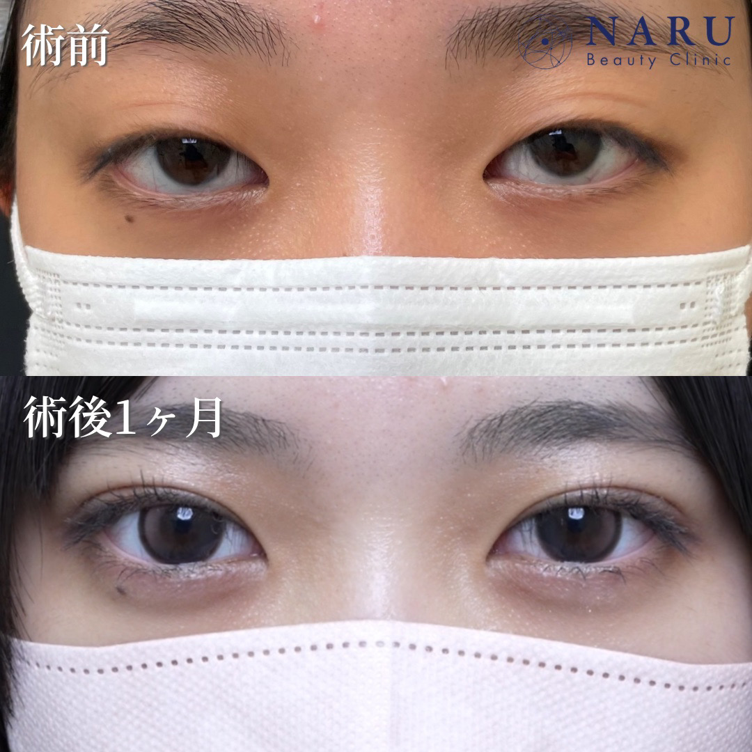 10代女性　二重埋没法