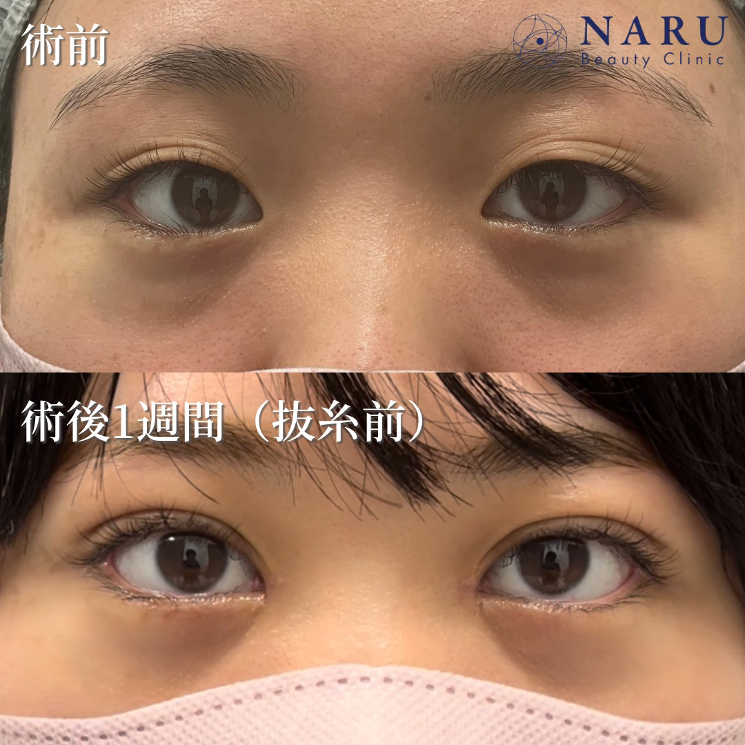 20代女性　二重埋没法＋クマ取り＋目頭切開