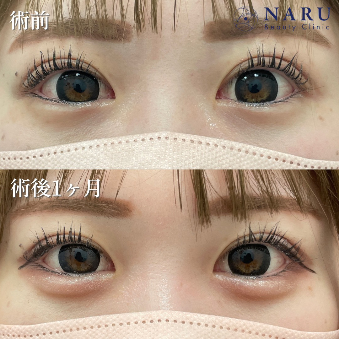 20代女性　涙袋ヒアルロン酸