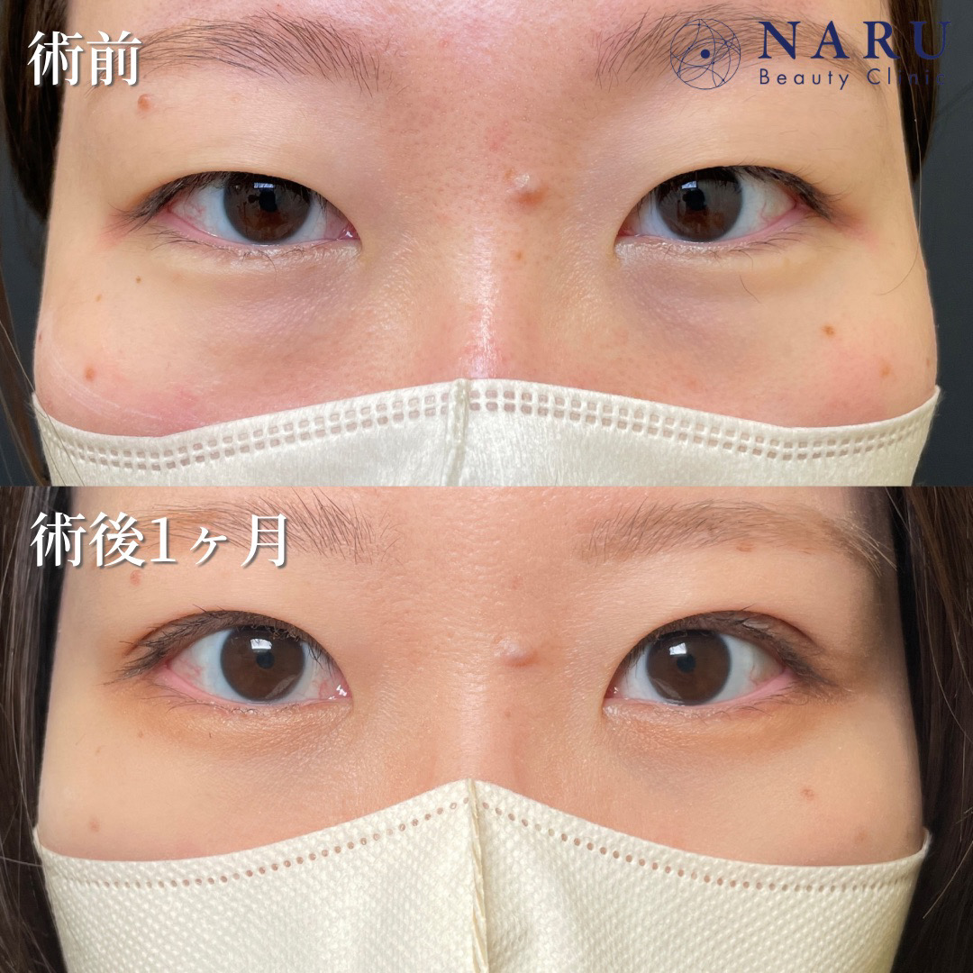 20代女性　二重埋没法＋クマ取り