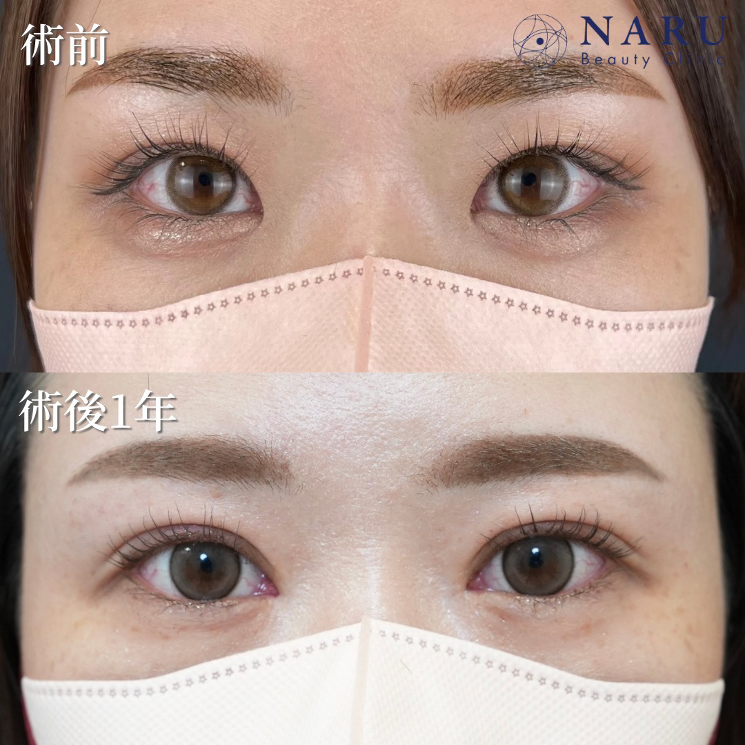 20代女性　二重埋没法＋目頭切開