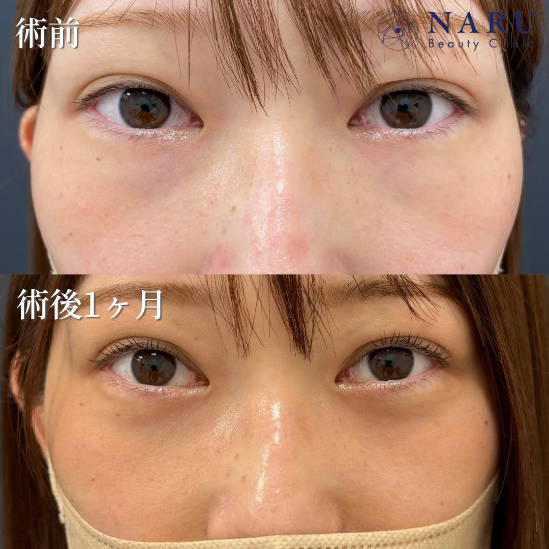 20代女性　クマ取り