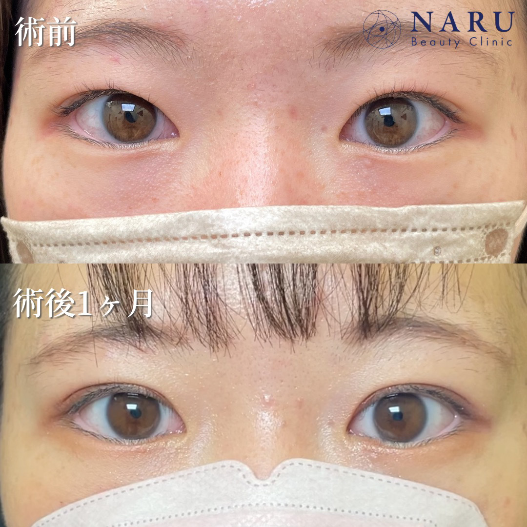 20代女性　二重埋没法