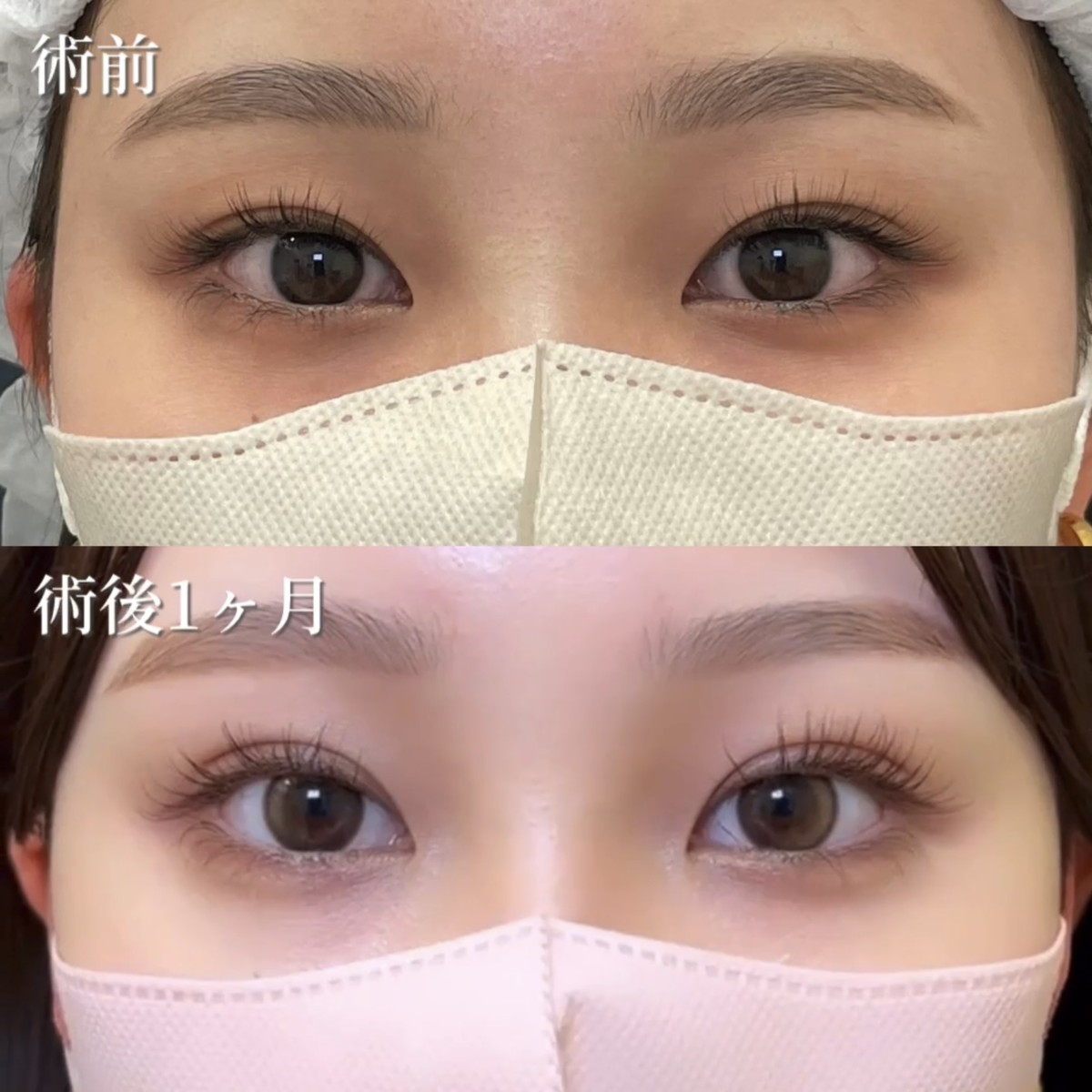 20代女性　二重埋没法