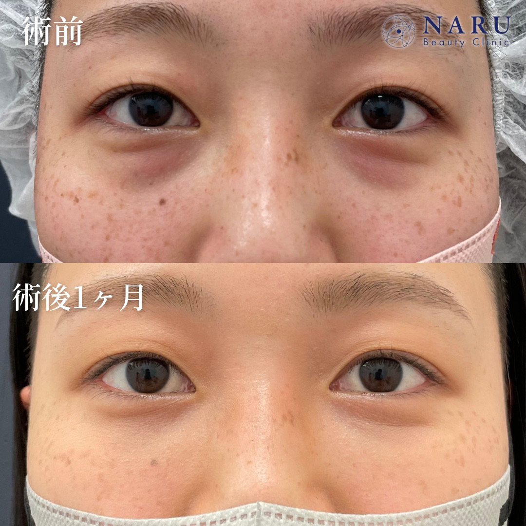 20代女性　クマ取り