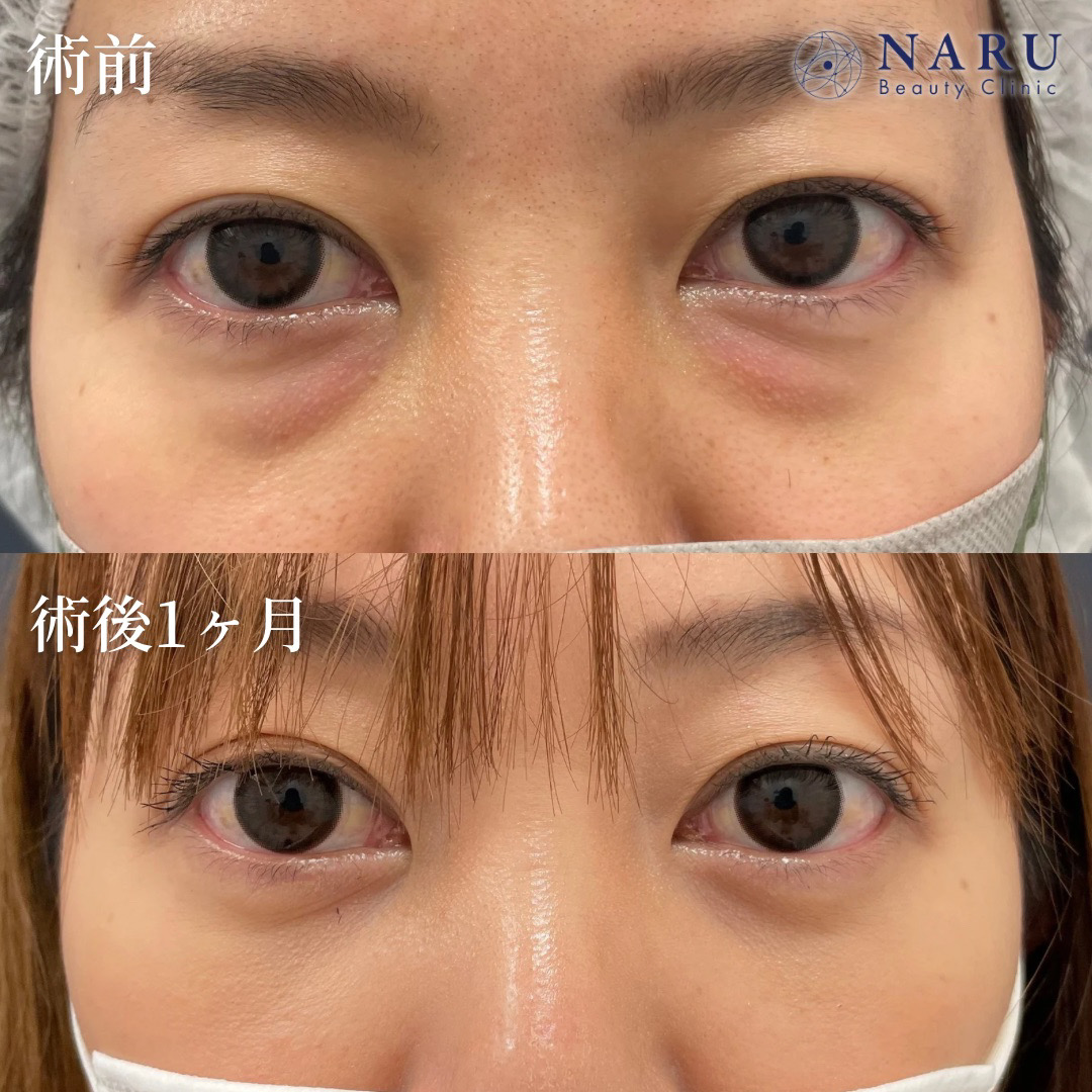 30代女性　クマ取り