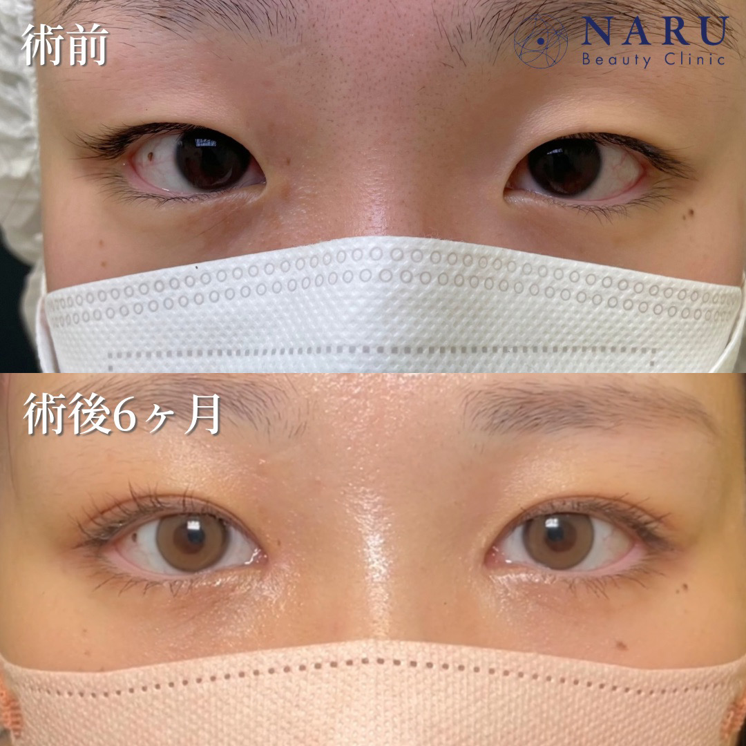 10代女性　二重埋没法　目頭切開