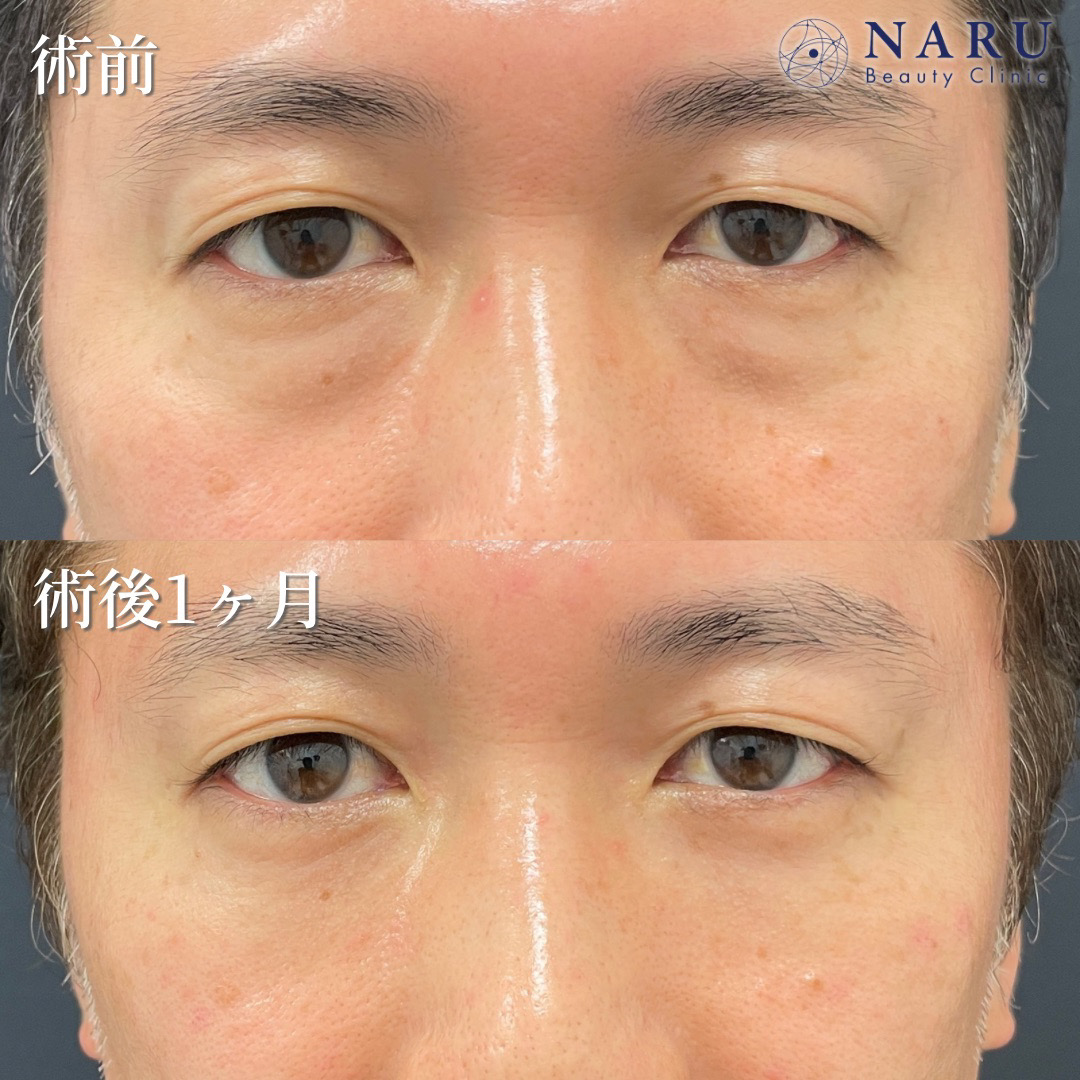 40代男性　クマ取り