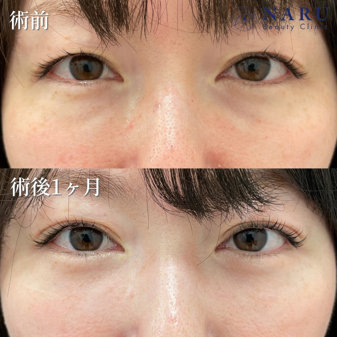 30代女性　二重埋没法　クマ取り