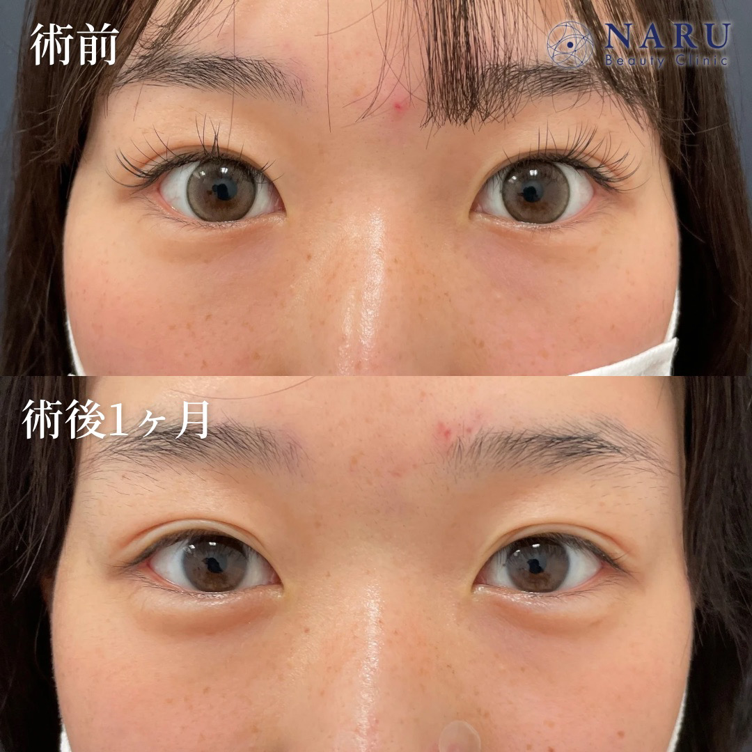 10代女性　涙袋ヒアルロン酸