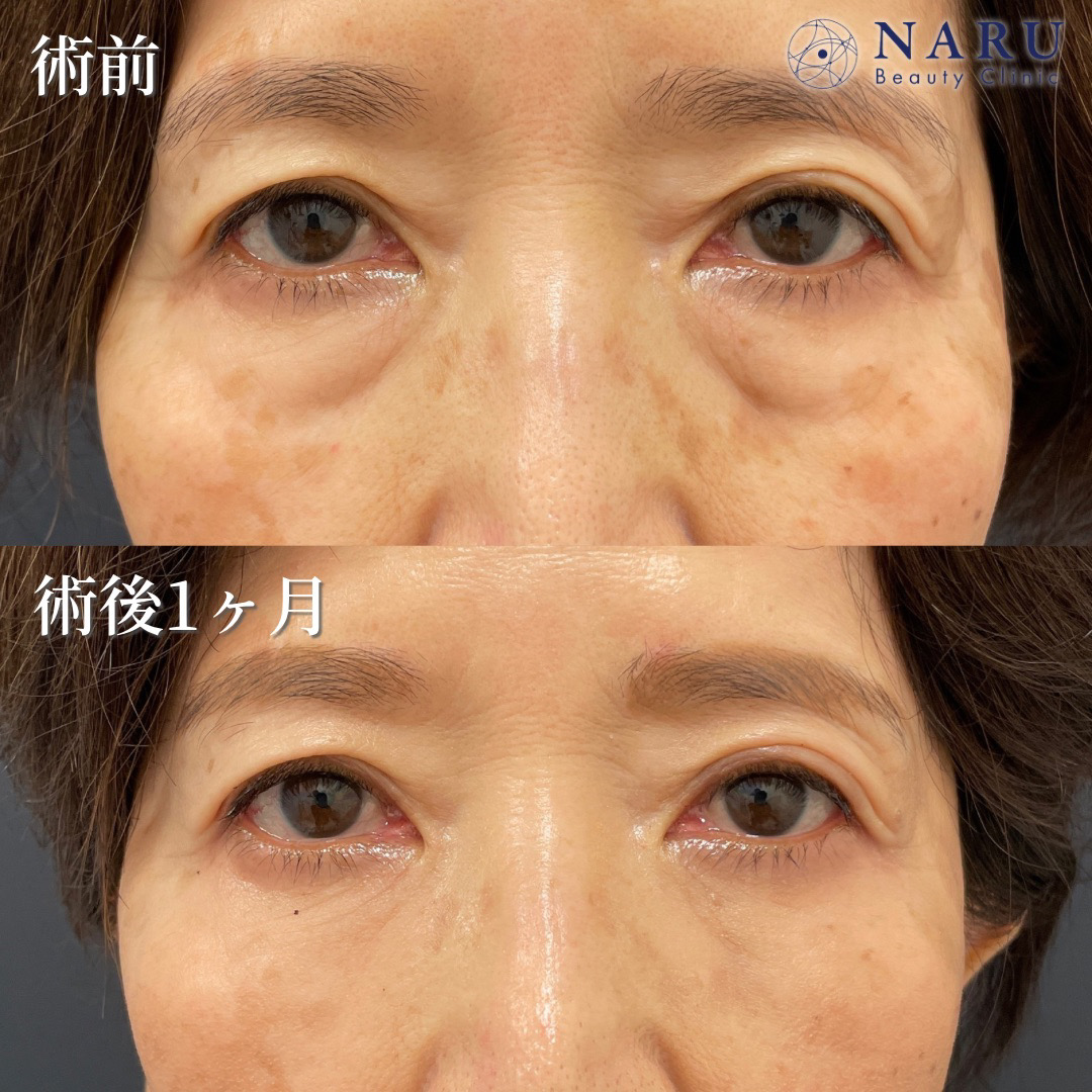 60代女性　クマ取り　脂肪注入