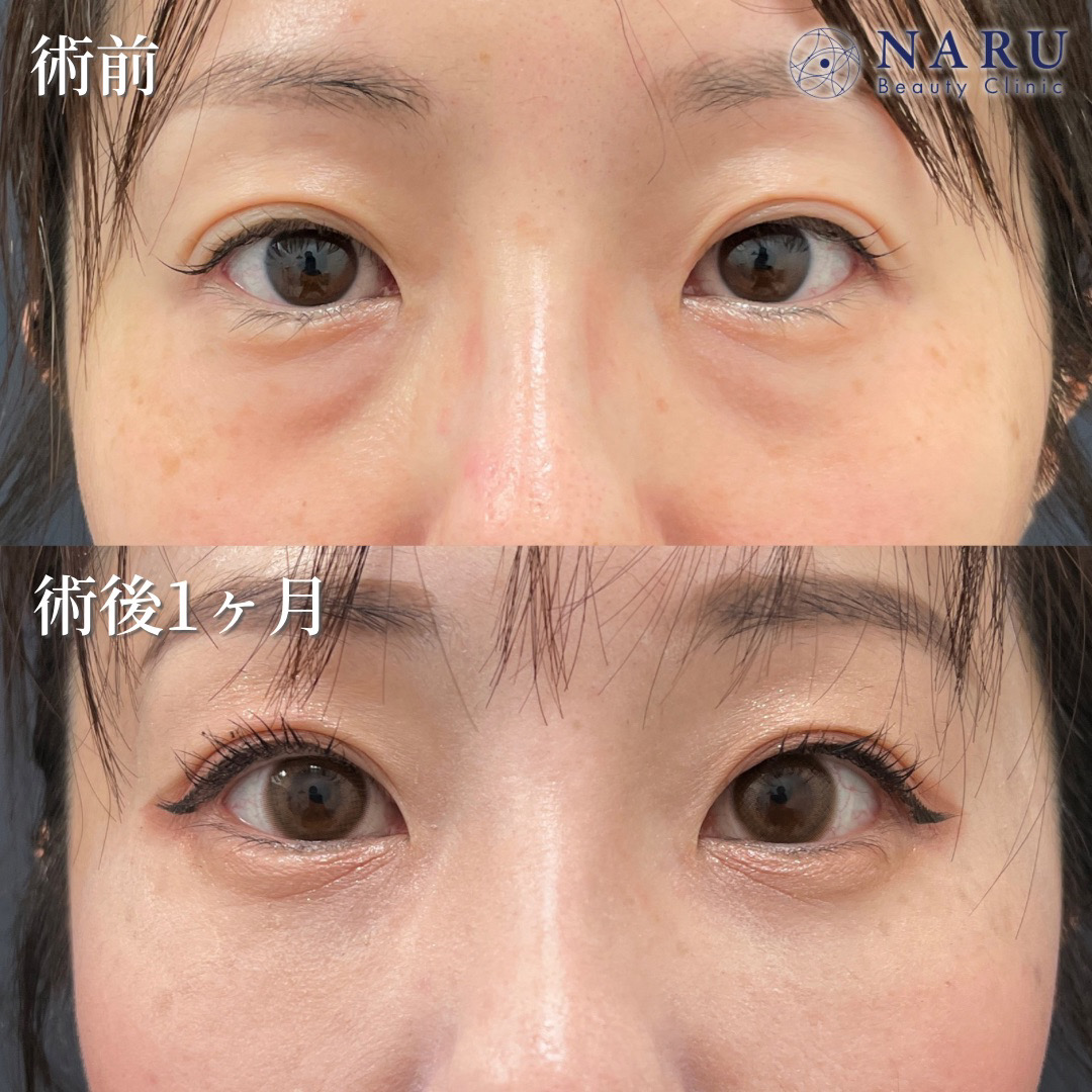 30代女性　クマ取り＋目の下の脂肪注入