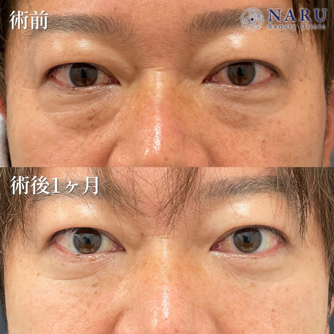 40代男性　クマ取り＋目の下の脂肪注入