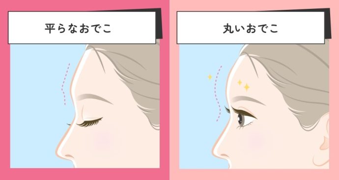 おでこ・こめかみのヒアルロン酸注射