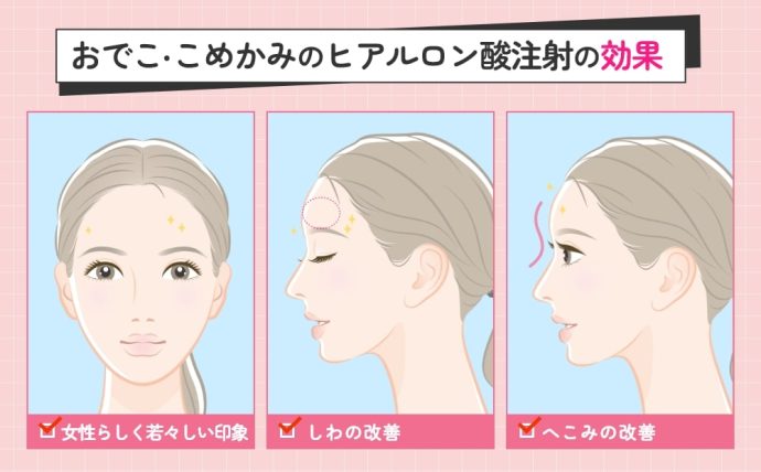 おでこ・こめかみのヒアルロン酸注射の効果