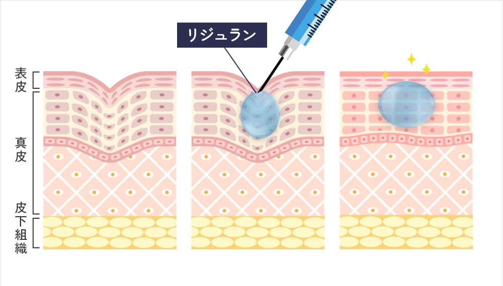 リジュラン（高濃度サーモン注射）とは